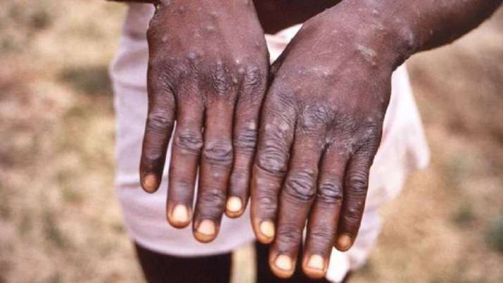ICMR conducts study on India's first fatal case of monkeypox from Kerala - Vimarsana News