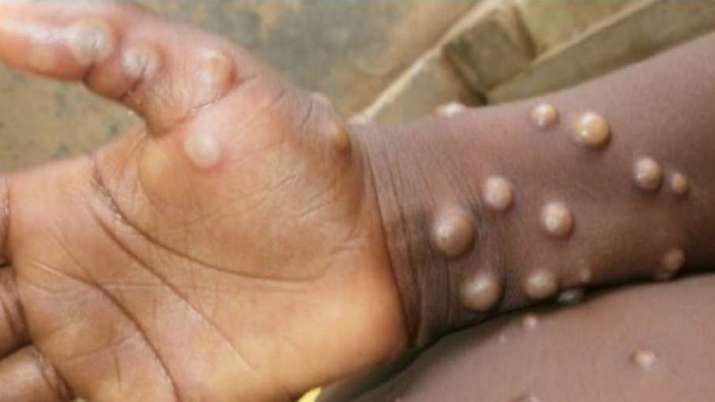 UK detects new variant of Monkeypox virus - Vimarsana News