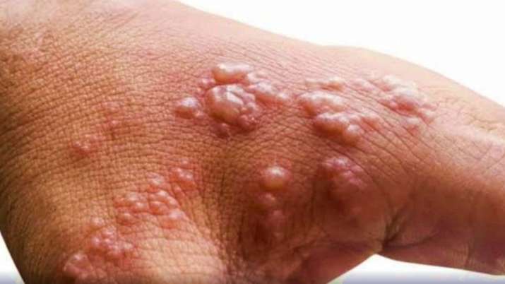 Monkeypox Scare: Australians warned to be on high alert against virus' symptoms - Vimarsana News