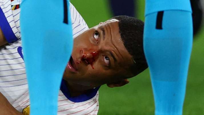 India Tv - Mbappe after being hit on his nose during the Austria match