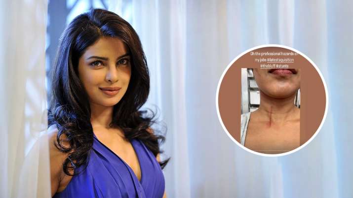 Priyanka Chopra injured while filming for ‘The Bluff’ in Australia; shares pic of her wound