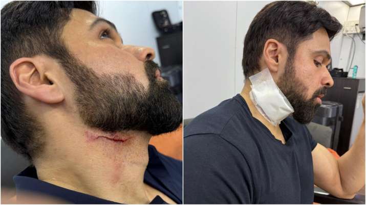 Emraan Hashmi suffers injuries during shoot of ‘Goodachari 2’ in Hyderabad, photos go viral