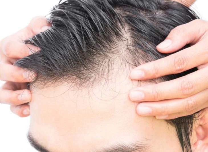 Say bye to Baldness as a new cure for hair loss is on the way | Lifestyle  News – India TV
