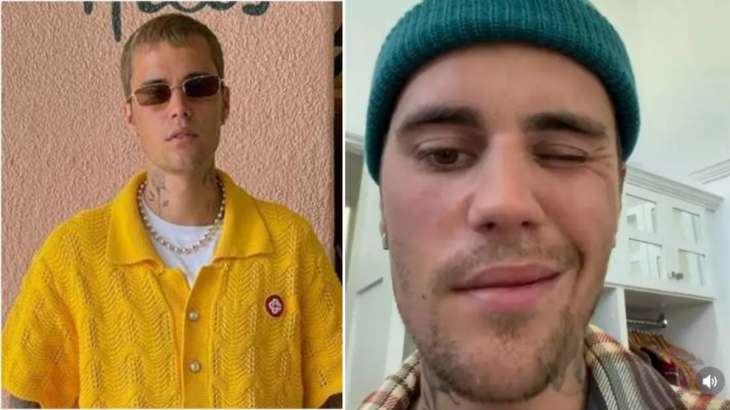 What Is Ramsay Hunt Syndrome Rare Condition That Made Justin Bieber Suffer From Facial 2351