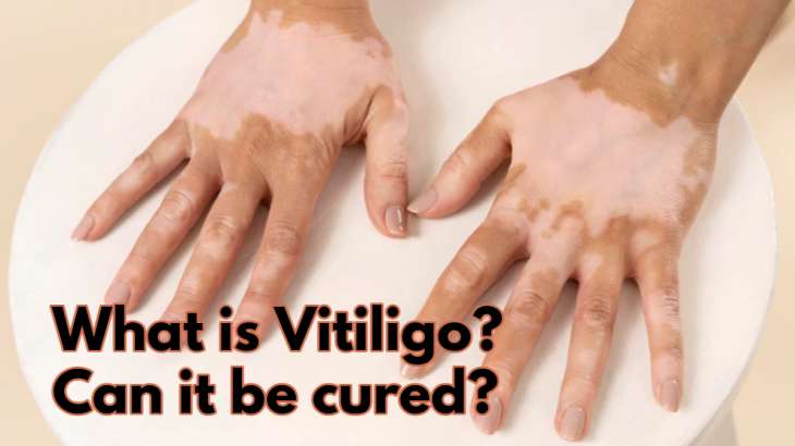 research on vitiligo cure