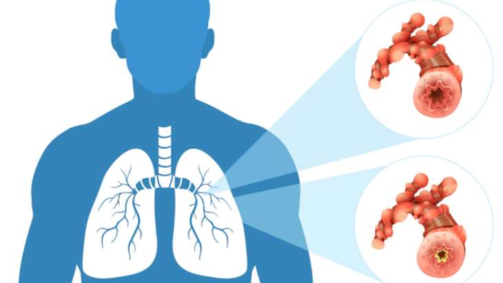 World Lung Cancer Day 2022: Know stages of lung cancer and at what ...