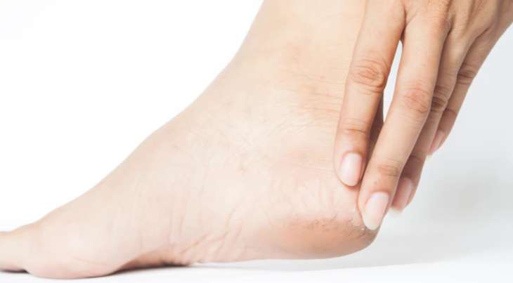 Moistursing the cracked heels is a good way to get a relief from the pain
