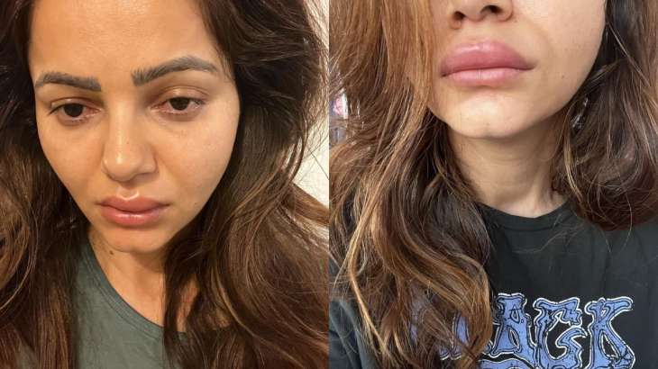Rubina Dilaik’s shocking photos of swollen face have fans concerned; actress says ‘I am frustated’