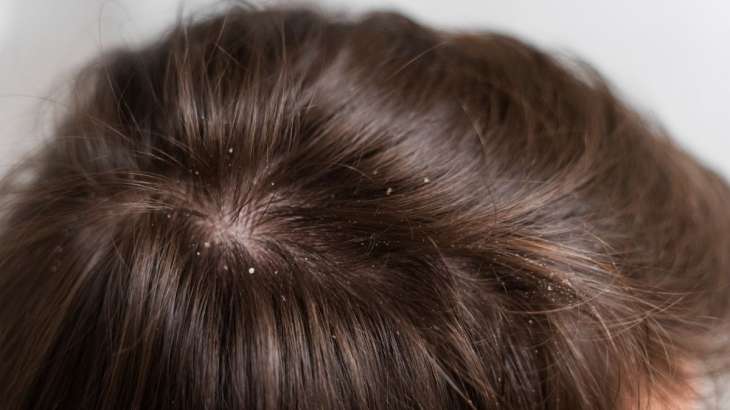 Home Remedies for Dandruff: Know these five natural methods to treat flakes  | Beauty News – India TV