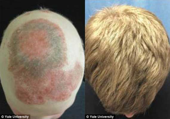 Arthritis Drug Spurs Hair Growth on Bald Mans Head