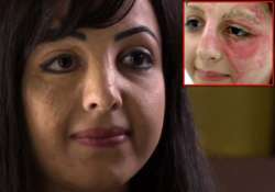 burnt at 3 basma hameed is a tattoo fairy for burn victims