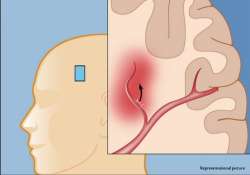 special protein in brain may up stroke risk study