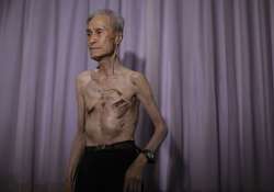 in pics nagasaki atomic bomb survivor shows his scars