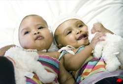 uk surgeons separate twin girls joined at head