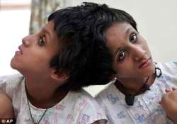 conjoined twins saba farah admitted to patna hospital