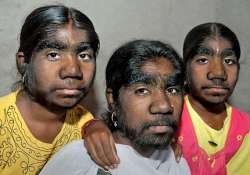 werewolf syndrome sangli sisters covered with hair want help for laser surgery