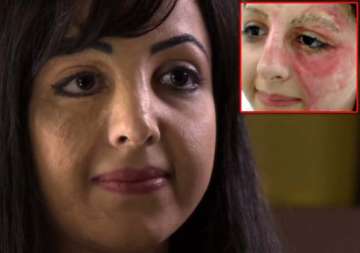 burnt at 3 basma hameed is a tattoo fairy for burn victims