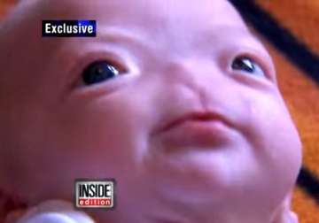 miracle baby without a nose is the newest internet star