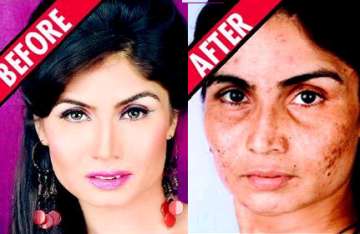 shilpa in a soup over botched skin treatment