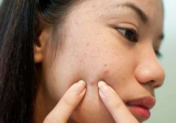 how to avoid or get rid of acne in the monsoon