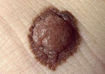 why moles sometimes develop into melanoma skin cancer