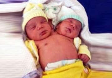 brazilian baby born with two heads