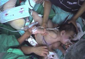 chile girl dies after surgery split her from conjoined twin