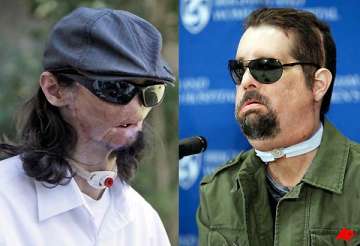 first full face transplant in us