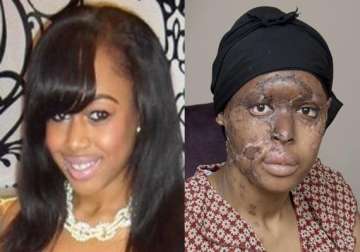 friend throws acid on nigerian student s face only because she was good looking