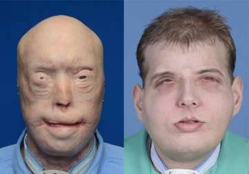 transplant gives new face scalp to burned firefighter