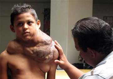 mexican boy has massive tumor removed in us