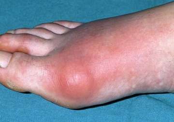 gout attacks more common at nights