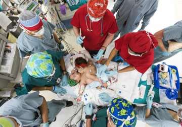 us surgeons separate 10 month old conjoined twin girls