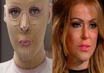 dana vulin fire attack victim reveals her face to the world
