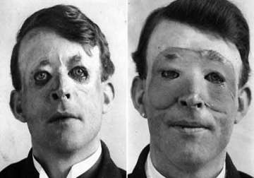 know the first person to go under knife for plastic surgery