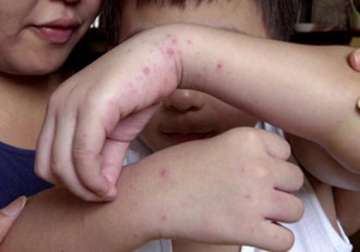 over 10 000 hit by hand foot mouth disease in vietnam