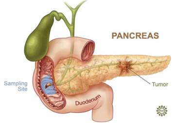 pancreatic cancer many diseases rolled into one