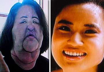 plastic surgery addict injects cooking oil into her own face