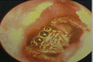 spider enters chinese woman s ear lives inside ear canal for 5 days