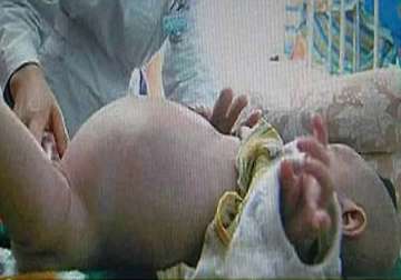two year old boy gives birth to his twin brother in china