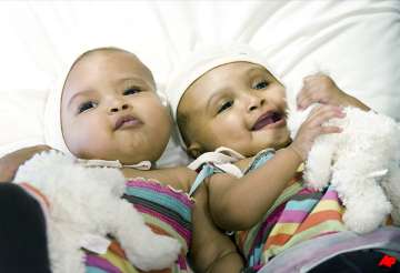 uk surgeons separate twin girls joined at head