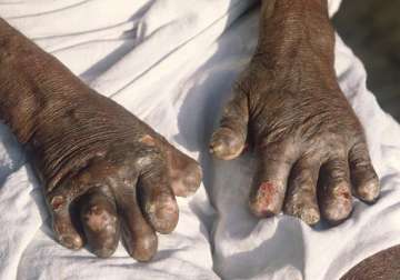 747 new leprosy cases in ne region centre worried