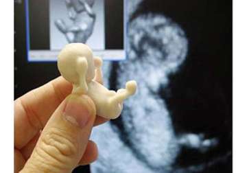 unborn baby s skeleton removed from woman s womb after 36 years