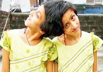 bihar s conjoined twins happy after sc rules out surgical separation