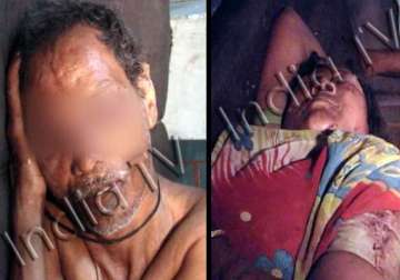 dalit couple s eyes pierced with scissors in chhatisgarh