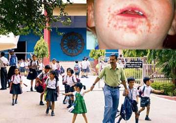 delhi school closes nursery after hand foot mouth disease spreads among kids