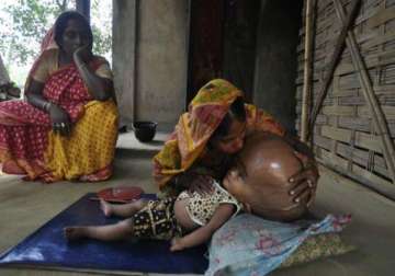 fortis doctors rule out immediate surgery for tripura girl roona with swollen head