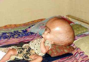 hydrocephalus parents of baby with enlarged head flown from tripura to delhi for treatment