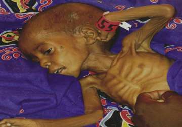 india has 40 per cent of world s malnourished expert