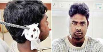 pune worker survives after rod pierces through his ear mouth
